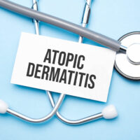 Top 9 Remedies for Atopic Dermatitis